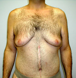 Gynecomastia Before & After Image