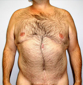 Gynecomastia Before & After Image