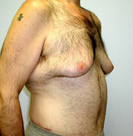 Gynecomastia Before & After Image