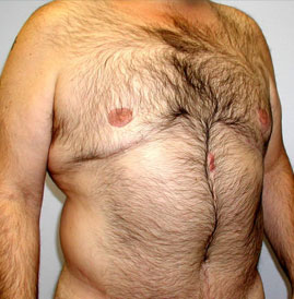 Gynecomastia Before & After Image