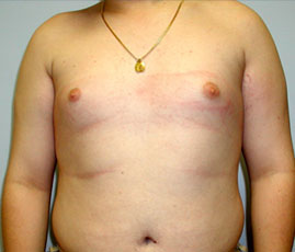 Gynecomastia Before & After Image