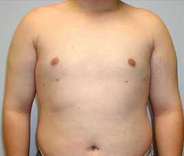 Gynecomastia Before & After Image