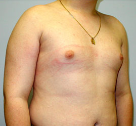 Gynecomastia Before & After Image