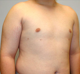 Gynecomastia Before & After Image