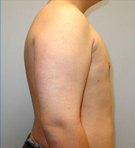 Gynecomastia Before & After Image