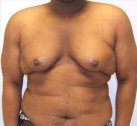 Gynecomastia Before & After Image