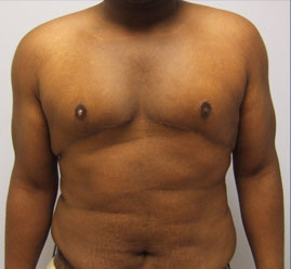 Gynecomastia Before & After Image