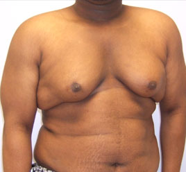 Gynecomastia Before & After Image