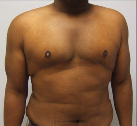 Gynecomastia Before & After Image