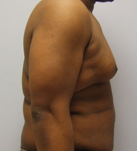 Gynecomastia Before & After Image