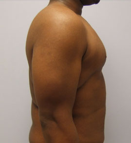 Gynecomastia Before & After Image