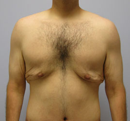 Gynecomastia Before & After Image