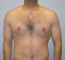 Gynecomastia Before & After Image