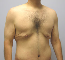 Gynecomastia Before & After Image