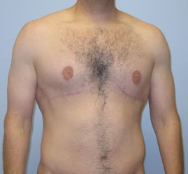 Gynecomastia Before & After Image