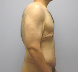 Gynecomastia Before & After Image