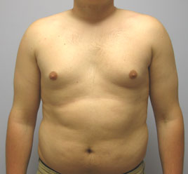 Gynecomastia Before & After Image