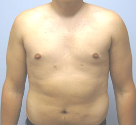 Gynecomastia Before & After Image