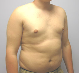 Gynecomastia Before & After Image