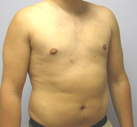 Gynecomastia Before & After Image