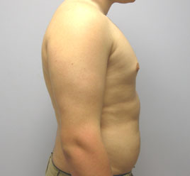 Gynecomastia Before & After Image