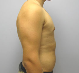 Gynecomastia Before & After Image