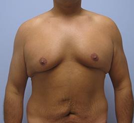 Gynecomastia Before & After Image