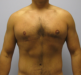 Gynecomastia Before & After Image