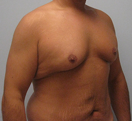 Gynecomastia Before & After Image