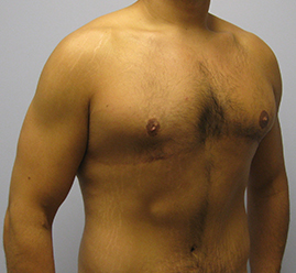 Gynecomastia Before & After Image