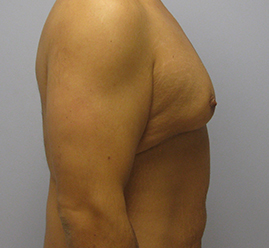 Gynecomastia Before & After Image