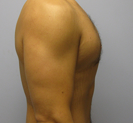 Gynecomastia Before & After Image