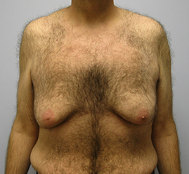 Gynecomastia Before & After Image