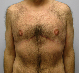 Gynecomastia Before & After Image