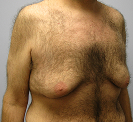 Gynecomastia Before & After Image