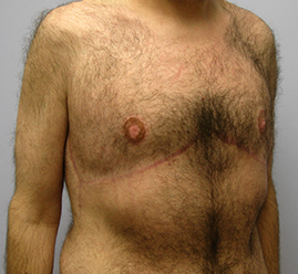 Gynecomastia Before & After Image