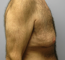 Gynecomastia Before & After Image