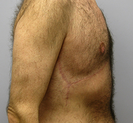 Gynecomastia Before & After Image