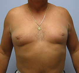 Gynecomastia Before & After Image