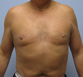 Gynecomastia Before & After Image