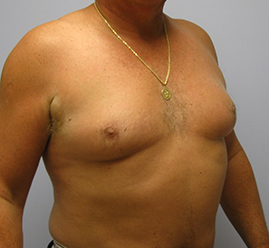 Gynecomastia Before & After Image