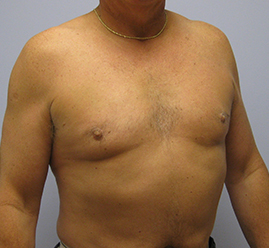 Gynecomastia Before & After Image