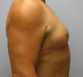 Gynecomastia Before & After Image