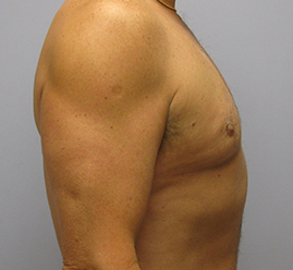 Gynecomastia Before & After Image