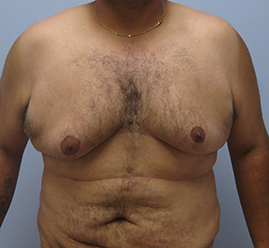 Gynecomastia Before & After Image