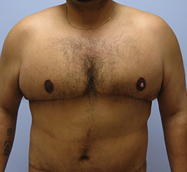 Gynecomastia Before & After Image