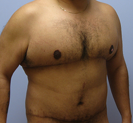 Gynecomastia Before & After Image