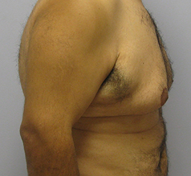 Gynecomastia Before & After Image