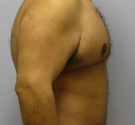 Gynecomastia Before & After Image