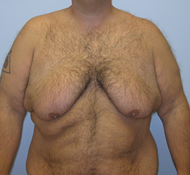 Gynecomastia Before & After Image